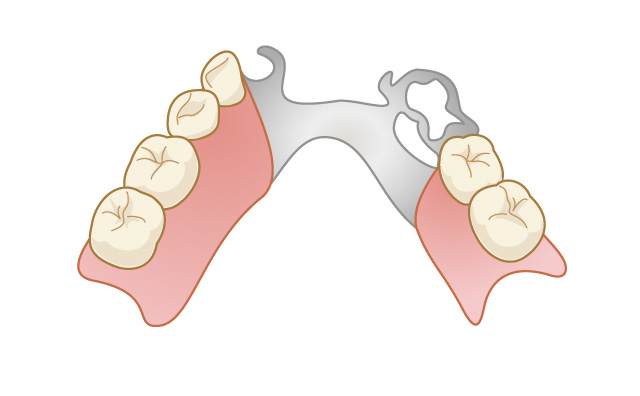 部分入れ歯のイメージ